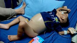 Kasihan!  Anak Tiga Tahun Asal WEK III Sidimpuan Terkena Tumor Perut